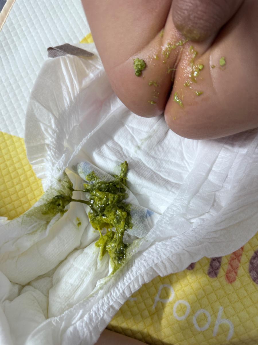 Chào add, con e bị tiêu chảy sau khi uống rotarix. Con bị khoảng 7 ngày rồi ạ, e có cho con uống men mà chưa khỏi, mấy ngày gần đây con đi khoảng 8lần/ngày. Hôm
Nay là ngày thứ 8, từ 5h sáng đến 5h chiều con đi 4 lần rồi ạ, mỗi lần đi ít phân có dịch nhầy. Chuyên gia cho e hỏi bây giờ e nên làm gì ạ? Có nên cho con đi khám luôn không hay theo dõi thêm mấy ngày nữa ah?