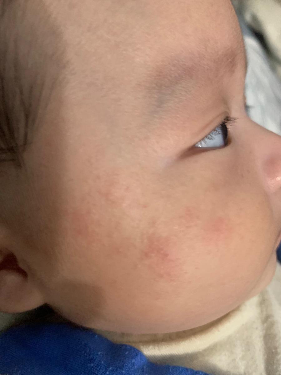 Bé nhà em bị nổi mụn giống như hình không biết có làm sao ko ạ. Nhờ mamibabi tư vấn với ạ.