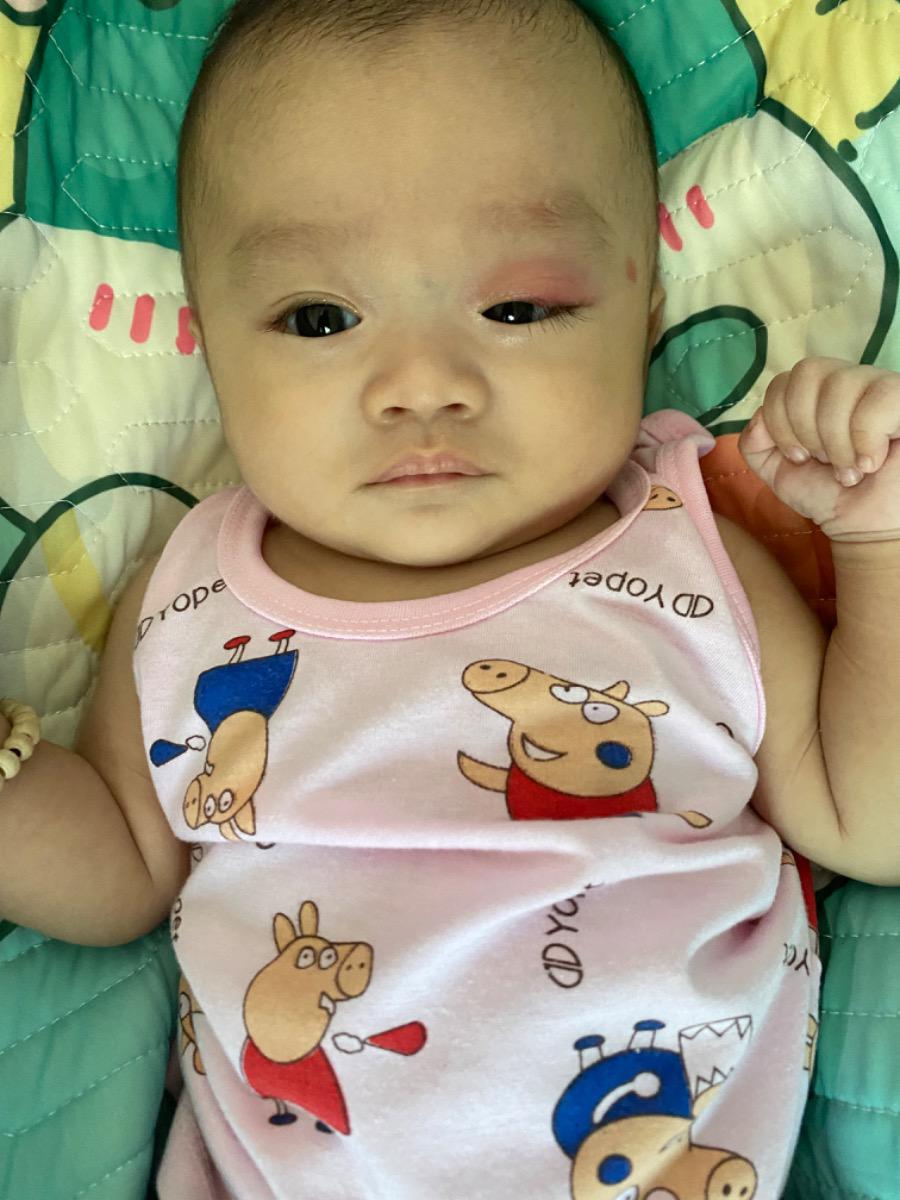 Bé nhà em được 2th20 ngày, hôm 5 Tây có đi tiêm 6in1, phế cầu và nhỏ rota, qua ngày hôm sau thì nổi 1 cái mụn như mụn gạo, đến hôm nay thì mắt bé đổ Ghèn và sưng đỏ lên như nổi lẹo thì nên vệ sinh hay làm thế nào ạ, có nên đi khám không, tại em sợ khám thì cho bé uống kháng sinh ko tốt ấy ạ. Và e xem lịch thì bé cũng đang nằm trong tuần khủng hoảng. Nên quấy khóc nhiều trong 2 hôm nay. Mong Mamibabi tư vấn 2 vấn đề trên giúp em. Em cảm ơn ak !!!