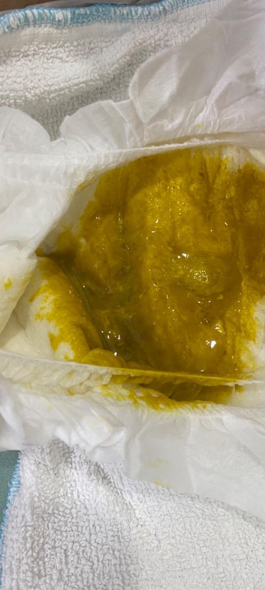 Con em lúc 2 tháng đi ngoài có sợi máu và phân nhầy nhiều. Mẹ kiêng bò và các chế phẩm từ bò thì bạn đi phân lỏng, hết nhầy và sợi máu. 
Nay con 4 tháng 14 ngày, em muốn thử lại để chọn sct cho con( vì mẹ cb đi làm). E có thử ăn sữa chua thì phân lại xuất hiện ít nhầy như hình. 
Nhờ anh chị tư vấn cho em với nhé