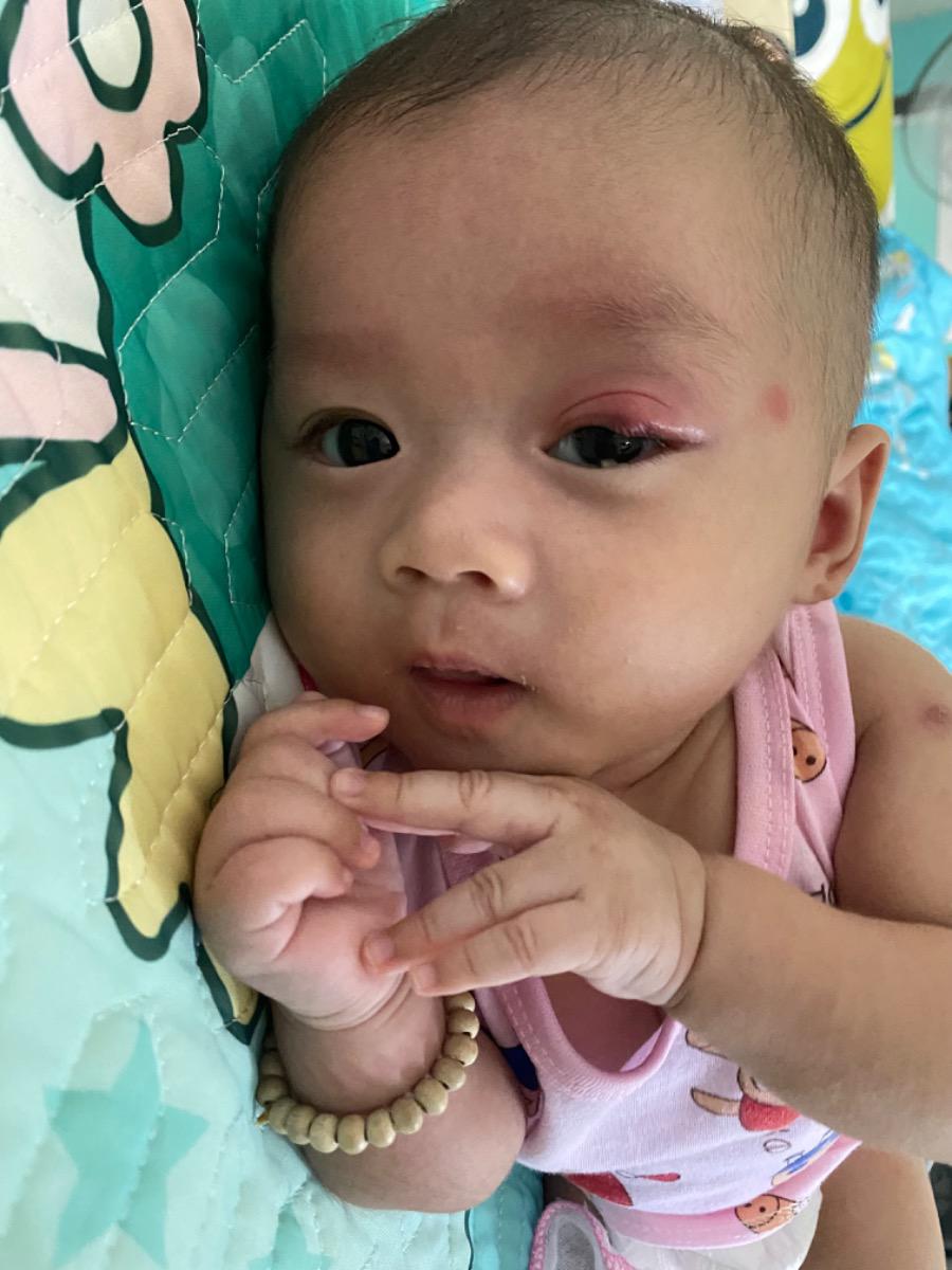 Bé nhà em được 2th20 ngày, hôm 5 Tây có đi tiêm 6in1, phế cầu và nhỏ rota, qua ngày hôm sau thì nổi 1 cái mụn như mụn gạo, đến hôm nay thì mắt bé đổ Ghèn và sưng đỏ lên như nổi lẹo thì nên vệ sinh hay làm thế nào ạ, có nên đi khám không, tại em sợ khám thì cho bé uống kháng sinh ko tốt ấy ạ. Và e xem lịch thì bé cũng đang nằm trong tuần khủng hoảng. Nên quấy khóc nhiều trong 2 hôm nay. Mong Mamibabi tư vấn 2 vấn đề trên giúp em. Em cảm ơn ak !!!