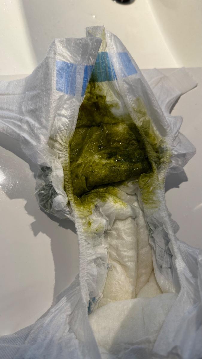 Con e nay tròn 7 tháng, hôm qua ăn uống bình thường nhưng có hiện tượng tiêu chảy phân xanh (như hình), 4-5 lần/ ngày. Bé có ăn dặm cháo (gạo+ sup lơ+ đậu hà lan+ khoai lang). 

Cho hỏi có phải bé tiêu chảy mọc răng (có hiện tượng hay cắn đồ vật, chảy dãi) hay bị gì? có nguy hiểm không? hiện tượng có kéo dài không? biện pháp? 

Xin cám ơn.