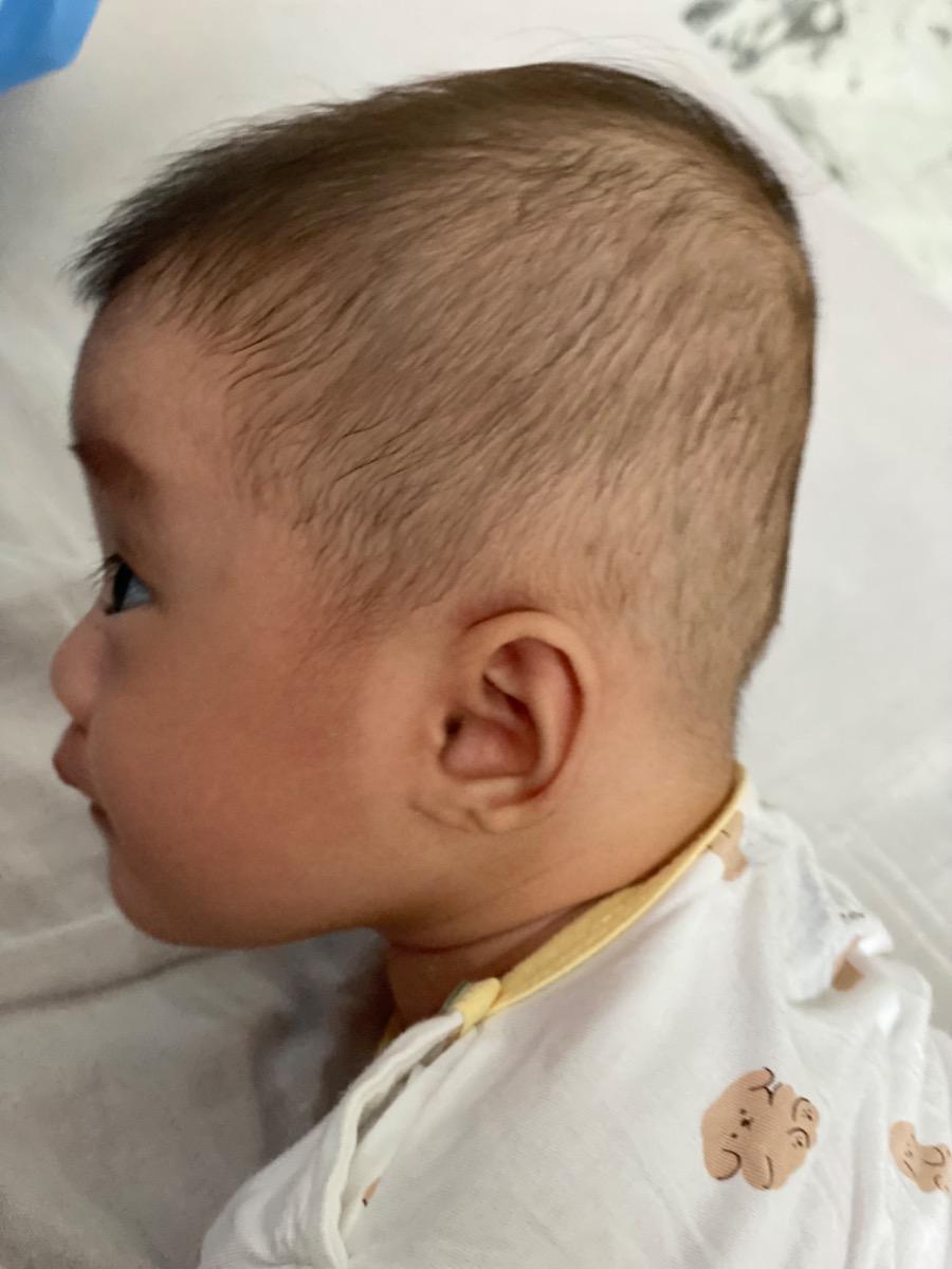 - Con e đang có tình trạng đầu phía sau như ảnh bên dưới, hình như bé bị bẹp đầu dưới thấy rõ luôn ạ. Bây giờ bé được 4 tháng rồi, thì làm sao để cải thiện tình trạng đầu của bé ạ, mặc dù bé cũng thường xuyên tự xoay và e cũng hỗ trợ nghiêng qua trái, qua phải cho bé trong lúc ngủ
- Khoảng 1 tuần gần đây, bé nhà e gặp thêm tình trạng là đôi khi vừa ăn xong là đi ngoài luôn, có khi phân xanh có khi phân vàng hơi lỏng ạ. Không biết là bị gì ạ, mong Mamibabi hỗ trợ tư vấn giúp em nhé 
Em cảm ơn ạ