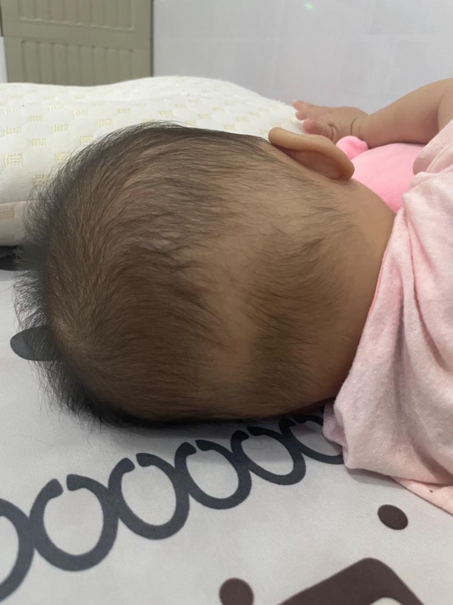 Cho e hỏi bé nhà e như thế này có phải là rụng tóc vành khăn k ạ? Bé biếng ăn và uống sữa  chỉ có 100-150ml/lần ạ