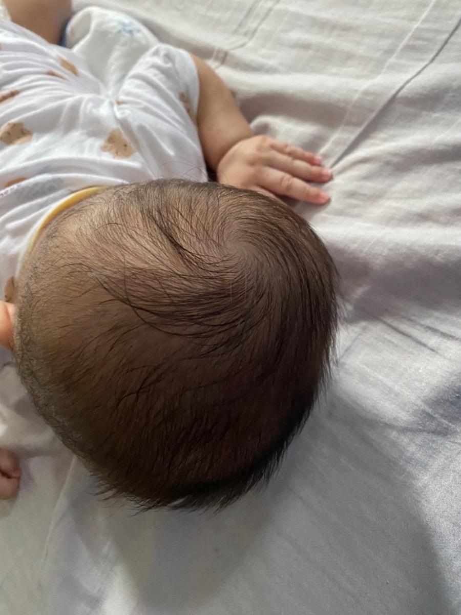 - Con e đang có tình trạng đầu phía sau như ảnh bên dưới, hình như bé bị bẹp đầu dưới thấy rõ luôn ạ. Bây giờ bé được 4 tháng rồi, thì làm sao để cải thiện tình trạng đầu của bé ạ, mặc dù bé cũng thường xuyên tự xoay và e cũng hỗ trợ nghiêng qua trái, qua phải cho bé trong lúc ngủ
- Khoảng 1 tuần gần đây, bé nhà e gặp thêm tình trạng là đôi khi vừa ăn xong là đi ngoài luôn, có khi phân xanh có khi phân vàng hơi lỏng ạ. Không biết là bị gì ạ, mong Mamibabi hỗ trợ tư vấn giúp em nhé 
Em cảm ơn ạ