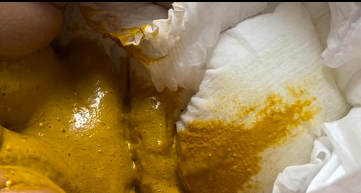 Bé mình đang ở thời kì giãn ruột, 10 ngày mới đi ngoài. Sau đó, 3 ngày bé đi lại, 3 lần trong 1 ngày. Phân vàng, bọt, có mùi hôi. Cho mình hỏi như hình là bình thường hay bé bị đau bụng ạ?