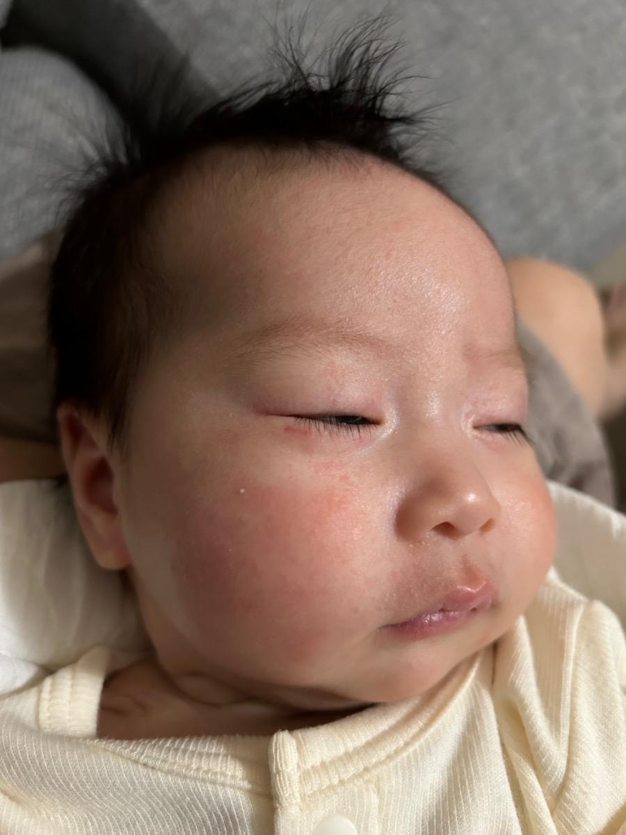 Chuyên gia tư vấn cho mình hỏi ạ.
Bé được gần 2m da nổi mẩn như vậy từ lúc ra tháng đến giờ.
Triệu chứng là nổi mần li ti, sờ vào thì sần sần, có màu đỏ ạ.
Mình xin cảm ơn ạ