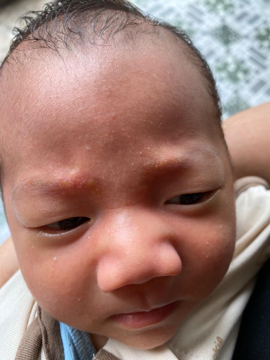 Bé được 1 tháng 1 tuần tuổi, bị nổi sẩn đỏ 2 đầu chân mày khoảng 2 tuần. Mình nghĩ là rôm sảy nên có tắm la trà xanh cho bé 3 lần. Nay chỗ sẩn đỏ có lớp vảy màu vàng như hình. Nhờ tư vấn giúp mình bệnh của bé có phải rôm sẩy hay chàm da ạ.