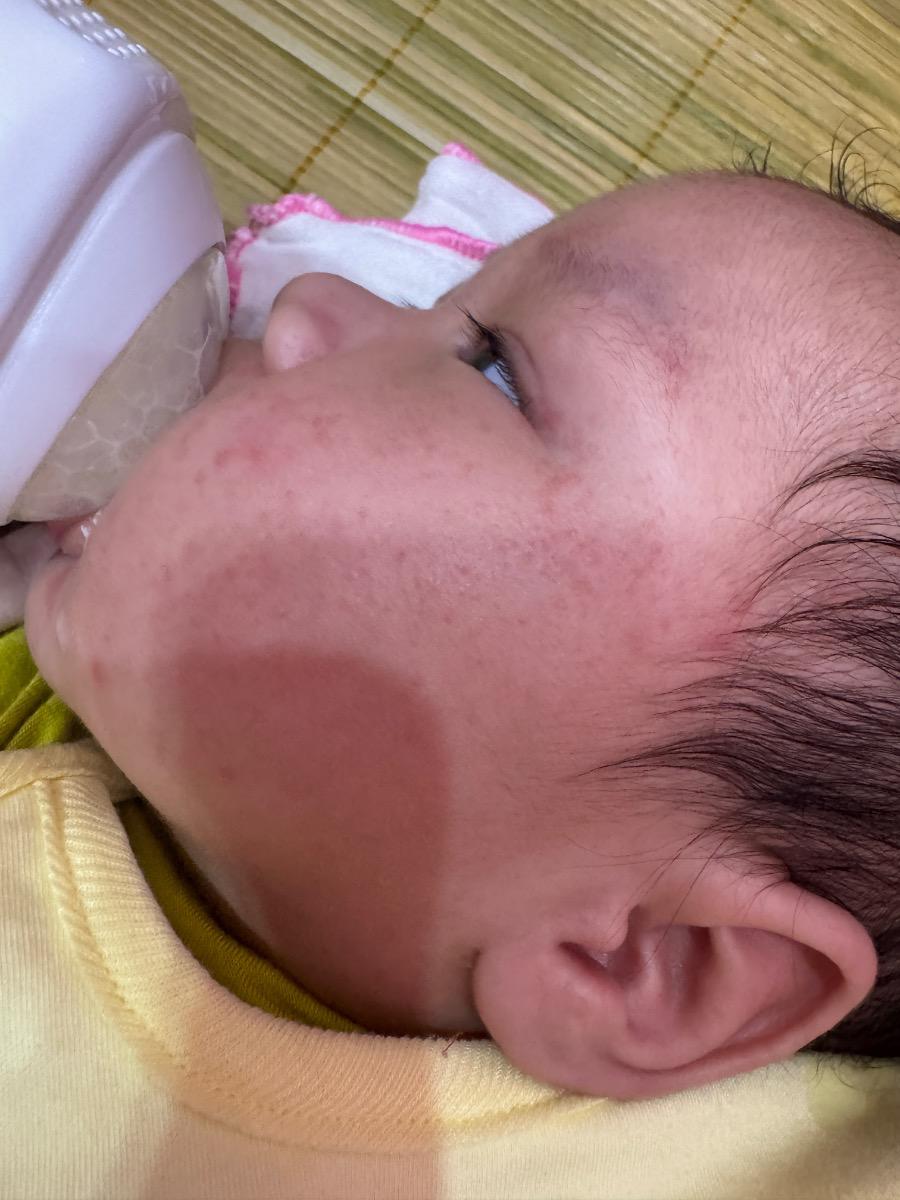 Bé e 3,5m. Bú mẹ dặm sct từ lúc sinh
Mấy hôm nay bé bú xong thấy mặt hay nổi chấm li ti như này ko biết bị làm sao ạ
Tư vấn giúp e
Bé bú aptamil anh từ sơ sinh đến giờ