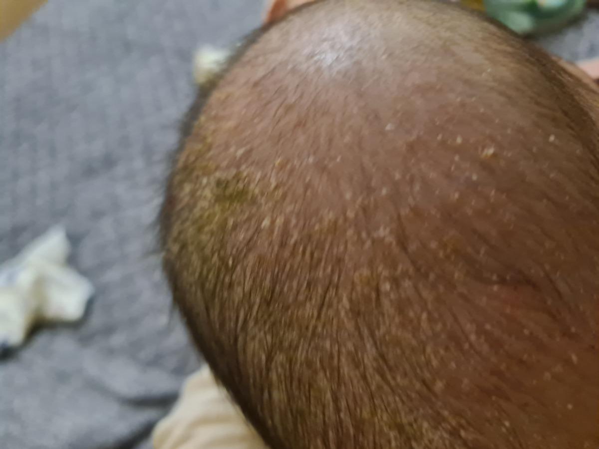 Bé nhà em bị mụn đỏ, nhà em gội đầu xong vỡ mụn và bị như này, em nên làm gì tiếp theo ạ!
E cảm ơn