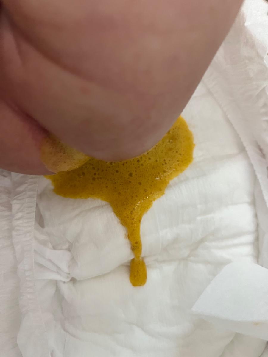 Né nhà em 1m23d, bú mẹ hoàn toàn, đợt này có dịp lúc thay bỉm được thấy con trực tiếp đùn phân ra, em mới phát hiện có bọt thế này. Còn bình thường, nếu phân trong bỉm có thể đã thấm nước, thì e k thấy bọt. Cho hỏi hiện tượng này có nguy hiểm k, xử lý tn ạ