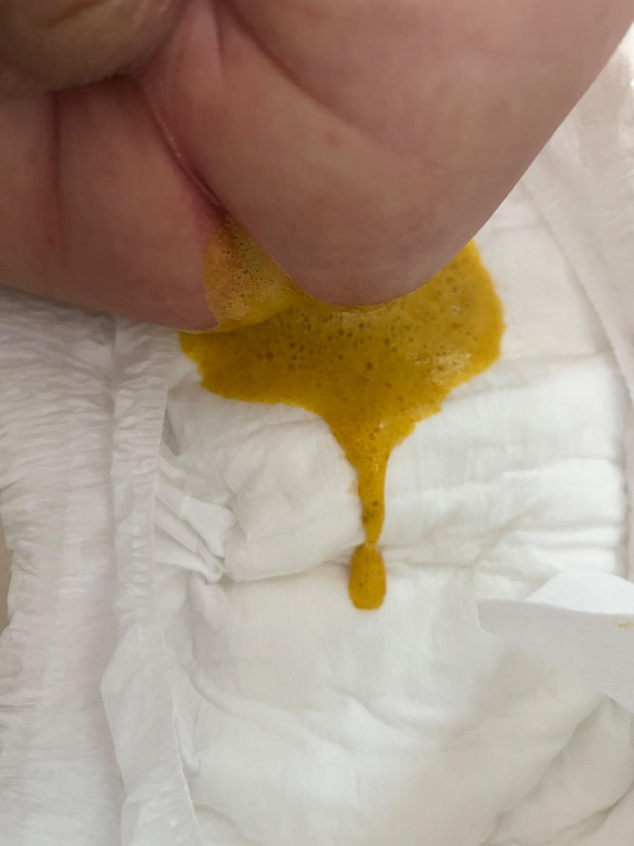 Né nhà em 1m23d, bú mẹ hoàn toàn, đợt này có dịp lúc thay bỉm được thấy con trực tiếp đùn phân ra, em mới phát hiện có bọt thế này. Còn bình thường, nếu phân trong bỉm có thể đã thấm nước, thì e k thấy bọt. Cho hỏi hiện tượng này có nguy hiểm k, xử lý tn ạ