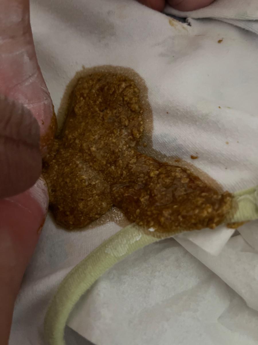 Bé nhà mình đi phân lỏng (vài ngày trước là 1lần/ngày. Hôm nay 3lần/ngày (2lần đi són + 1lần như hình) kèm bú ít và quấy khóc khi vào giấc. Nhờ mamibabi xem giúp có phải bé bị tiêu chảy không? Nếu có thì tư vấn giúp mình biện pháp tạm thời tại nhà. Xin cảm ơn.