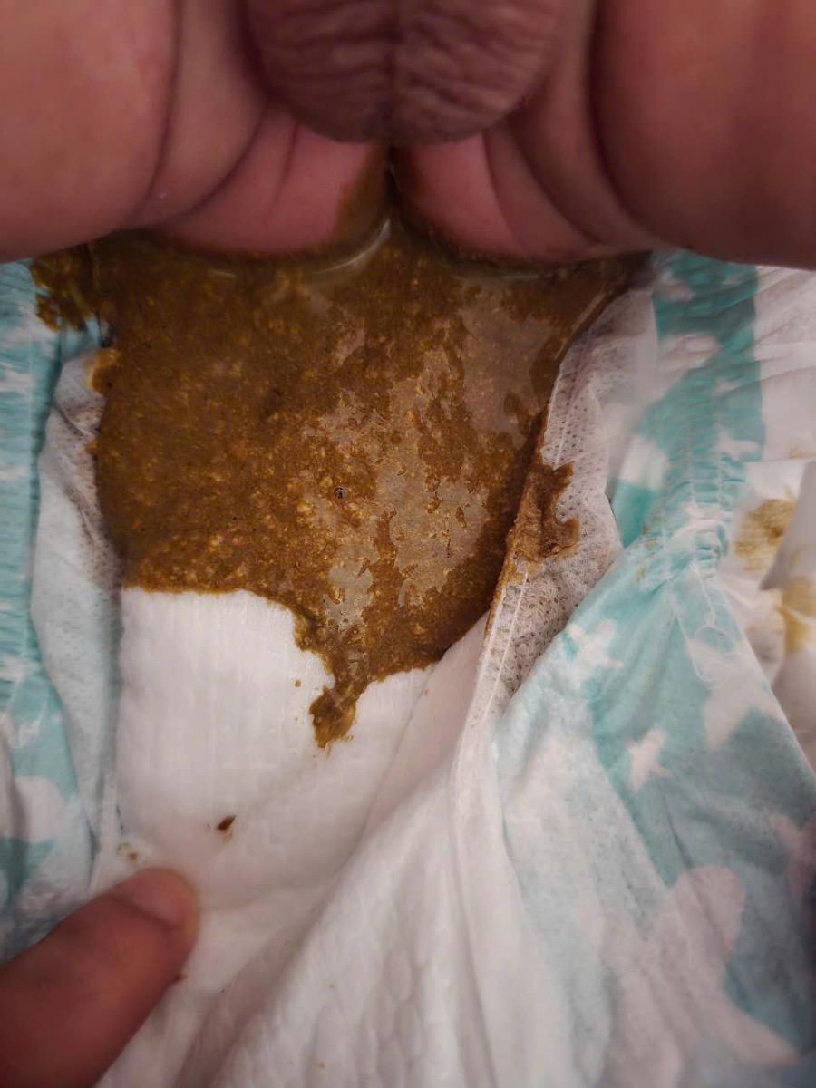 Bé nhà mình đi phân lỏng (vài ngày trước là 1lần/ngày. Hôm nay 3lần/ngày (2lần đi són + 1lần như hình) kèm bú ít và quấy khóc khi vào giấc. Nhờ mamibabi xem giúp có phải bé bị tiêu chảy không? Nếu có thì tư vấn giúp mình biện pháp tạm thời tại nhà. Xin cảm ơn.