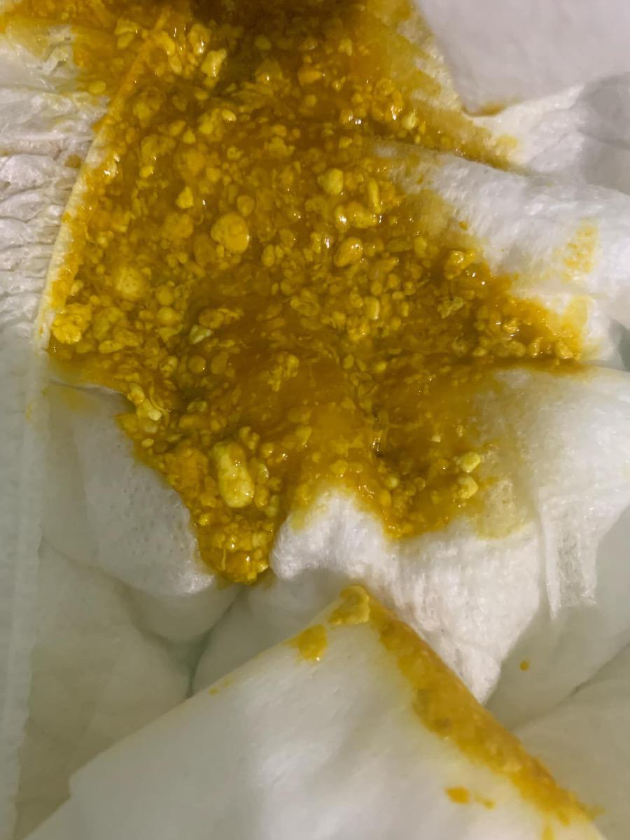 Bé nhà mình được 1m20d đi phân như này có vấn đề gì không ạ. Có bác nào biết nhờ tư vấn giúp mình với ạ. Mình cảm ơn ạ!
