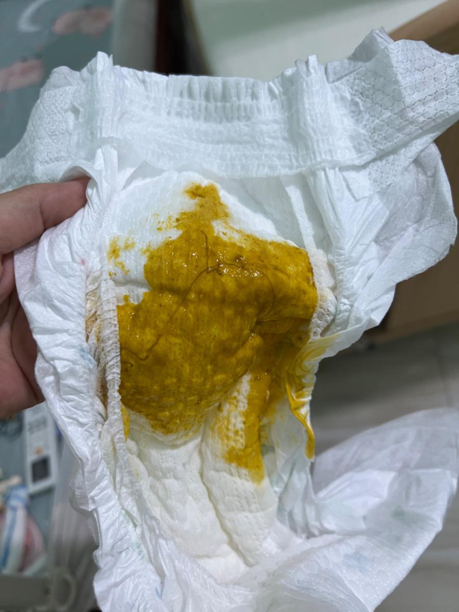 Bé nhà mình theo dõi dị ứng đạm bò, bé thường đi phân nhầy nhưng hôm nay phân có 1 sợi dài như trong ảnh đi kèm. Liệu đây có phải vấn đề bất thường không ạ? Con bú mẹ hoàn toàn