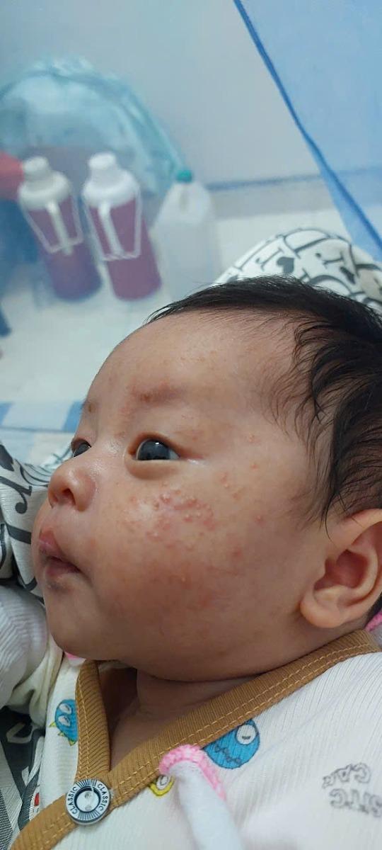 Em chào bác sĩ ạ. Con em được khoảng 1 tháng tuổi. Trên mặt, đầu, cổ, lưng xuất hiện nhiều nốt đỏ mủ trắng. Chủ yếu tập trung ở mặt r bị lan ra các vùng khác. Em có tìm hiểu trên mạng và đã thử cho bé tắm lá và bôi kem đặc trị viêm da cơ đia hoặc chàm sữa nhưng vẫn chưa khỏi và có dấu hiệu bị lẫn nhiều hơn. Nên em sợ mình phán đoán sai. Nhờ bác sĩ tư vấn giúp em xem bé bị bệnh ngoài da nào ạ.