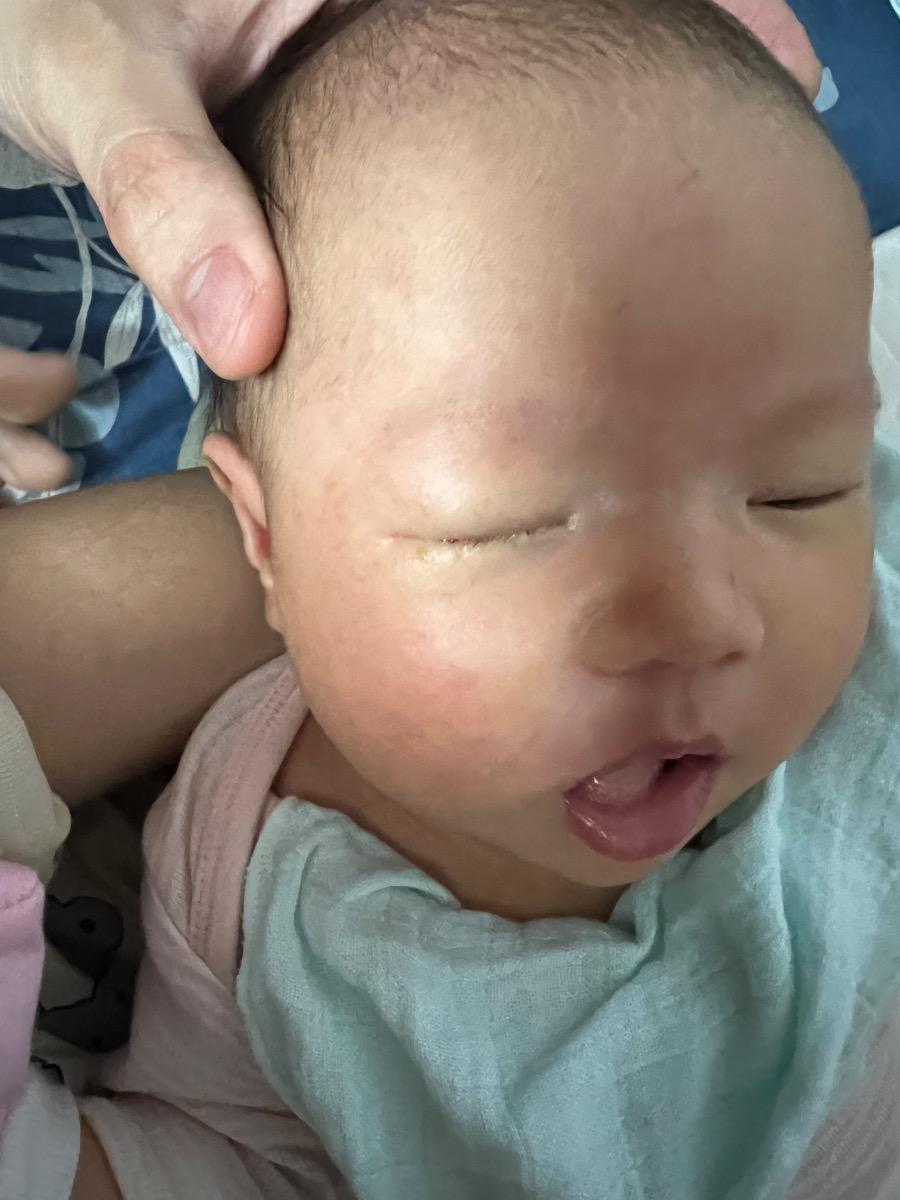 Như hình ảnh m gửi nha bạn. Bạn xem giúp mình với, và thường do bị gi mà cháu bị thế này để m tránh. Đang lo là tay bé ngoắc vào mắt khi bé 28 ngày tuổi hay bị ợ trớ đầy hơi bạn ạ. Cảm ơn.