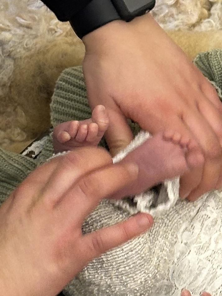 Chào các bạn,
Bé mình vừa sinh thì thấy bên chân trái ngón út chồng lên ngón áp út như hình. Cho mình hỏi đây là hiện tượng gì, vì sao bị vậy và cách cải thiện ạ.
Mình cảm ơn nhiều ạ.