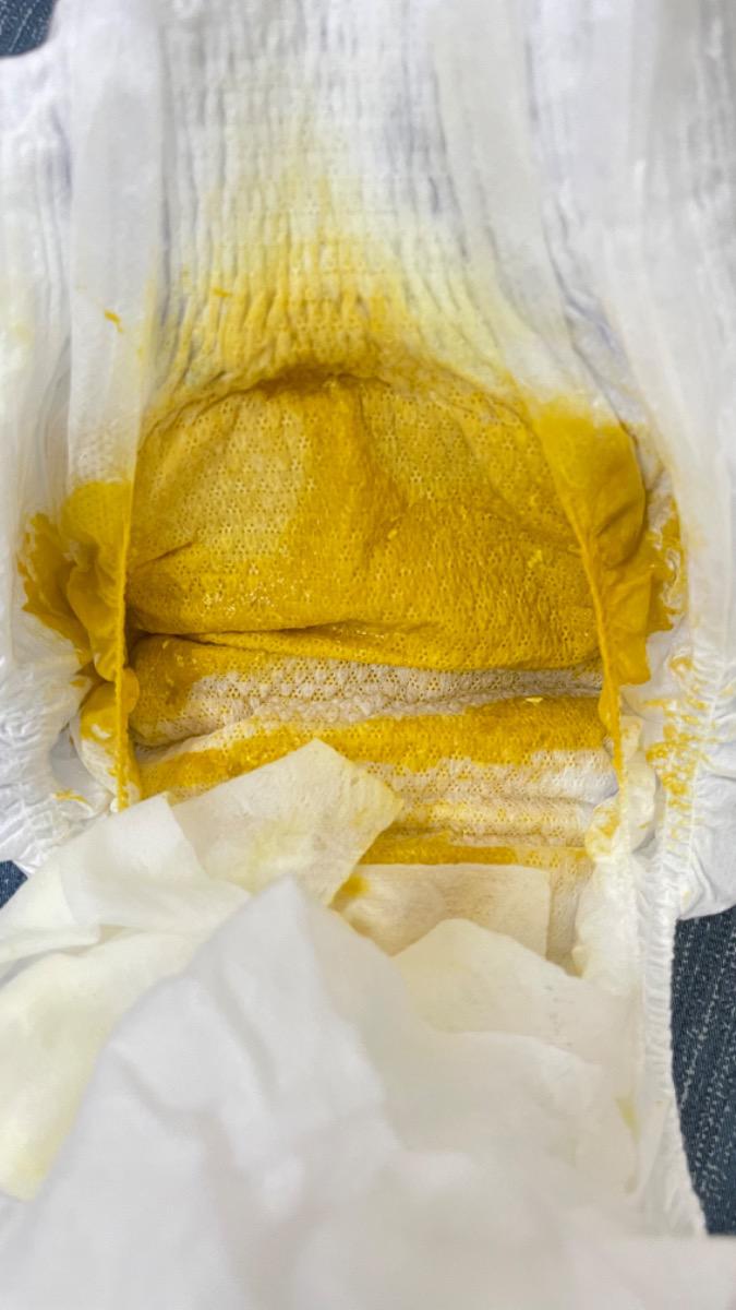 Cho mình hỏi chút, bé nhà mình hiện tại được 2 tháng 10 ngày. 
Từ 01/03 trở về trước: đi ngoài bình thường. 
01-04/03: không đi ngoài. 
Ngày 05/03: đi ngoài 2 lượt, phân lỏng. 
06-08/03: không đi ngoài.
Ngày 09/03: đi ngoài 2 lượt, phân lỏng như dưới hình. 
Nhờ Mamibabi xem giúp có phải bé bị tiêu chảy không? Có phải bé đang trong thời kỳ giãn ruột sinh lý không?
Note: Mình có cho bé dùng D3 của Nordic hàng ngày và bổ sung men vi sinh Bioamicus cho bé từ ngày 01/03.