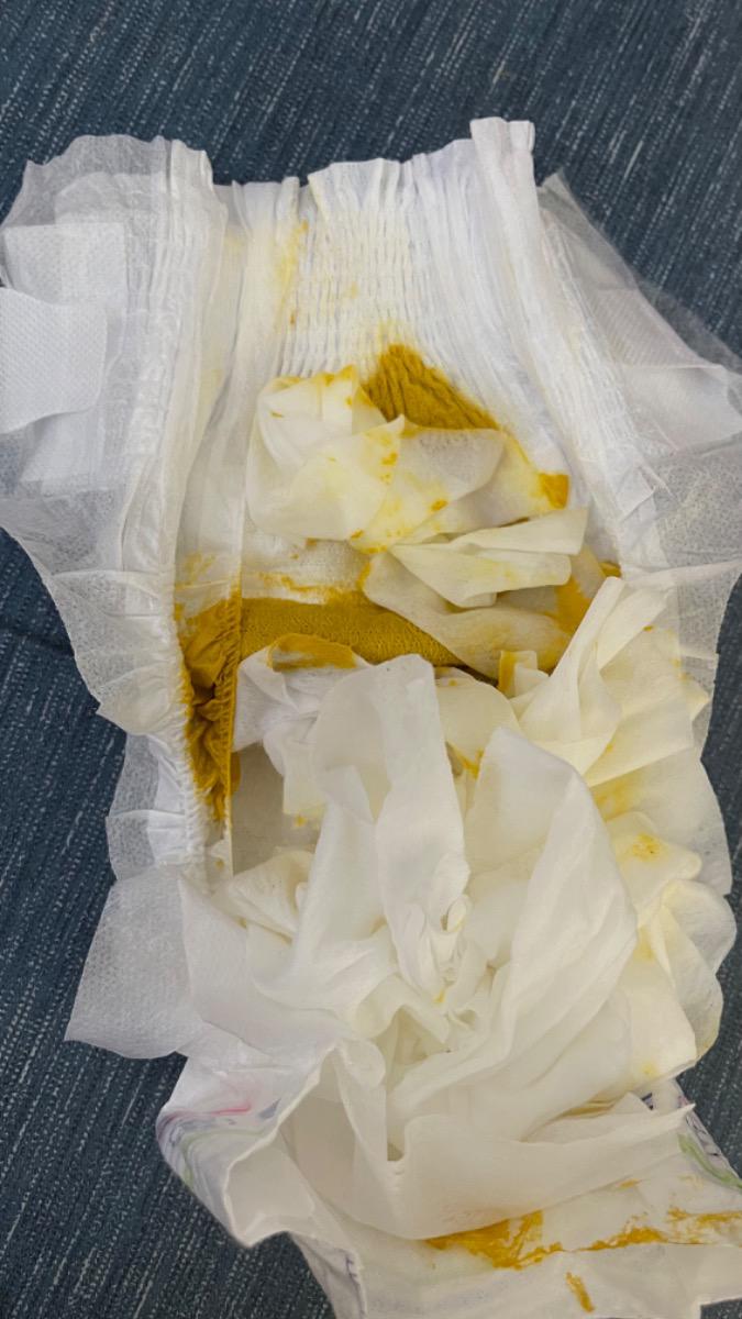 Cho mình hỏi chút, bé nhà mình hiện tại được 2 tháng 10 ngày. 
Từ 01/03 trở về trước: đi ngoài bình thường. 
01-04/03: không đi ngoài. 
Ngày 05/03: đi ngoài 2 lượt, phân lỏng. 
06-08/03: không đi ngoài.
Ngày 09/03: đi ngoài 2 lượt, phân lỏng như dưới hình. 
Nhờ Mamibabi xem giúp có phải bé bị tiêu chảy không? Có phải bé đang trong thời kỳ giãn ruột sinh lý không?
Note: Mình có cho bé dùng D3 của Nordic hàng ngày và bổ sung men vi sinh Bioamicus cho bé từ ngày 01/03.