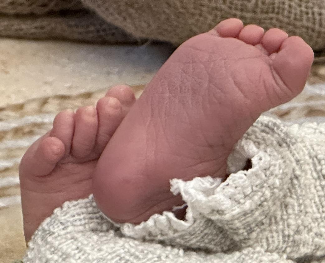 Chào các bạn,
Bé mình vừa sinh thì thấy bên chân trái ngón út chồng lên ngón áp út như hình. Cho mình hỏi đây là hiện tượng gì, vì sao bị vậy và cách cải thiện ạ.
Mình cảm ơn nhiều ạ.