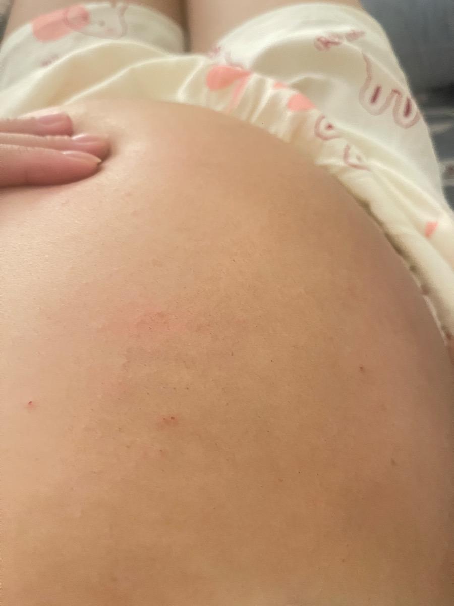 Bị nổi sảy ở bụng. Khá ngứa. Nên làm gì? Xuất hiện khoảng 3 ngày