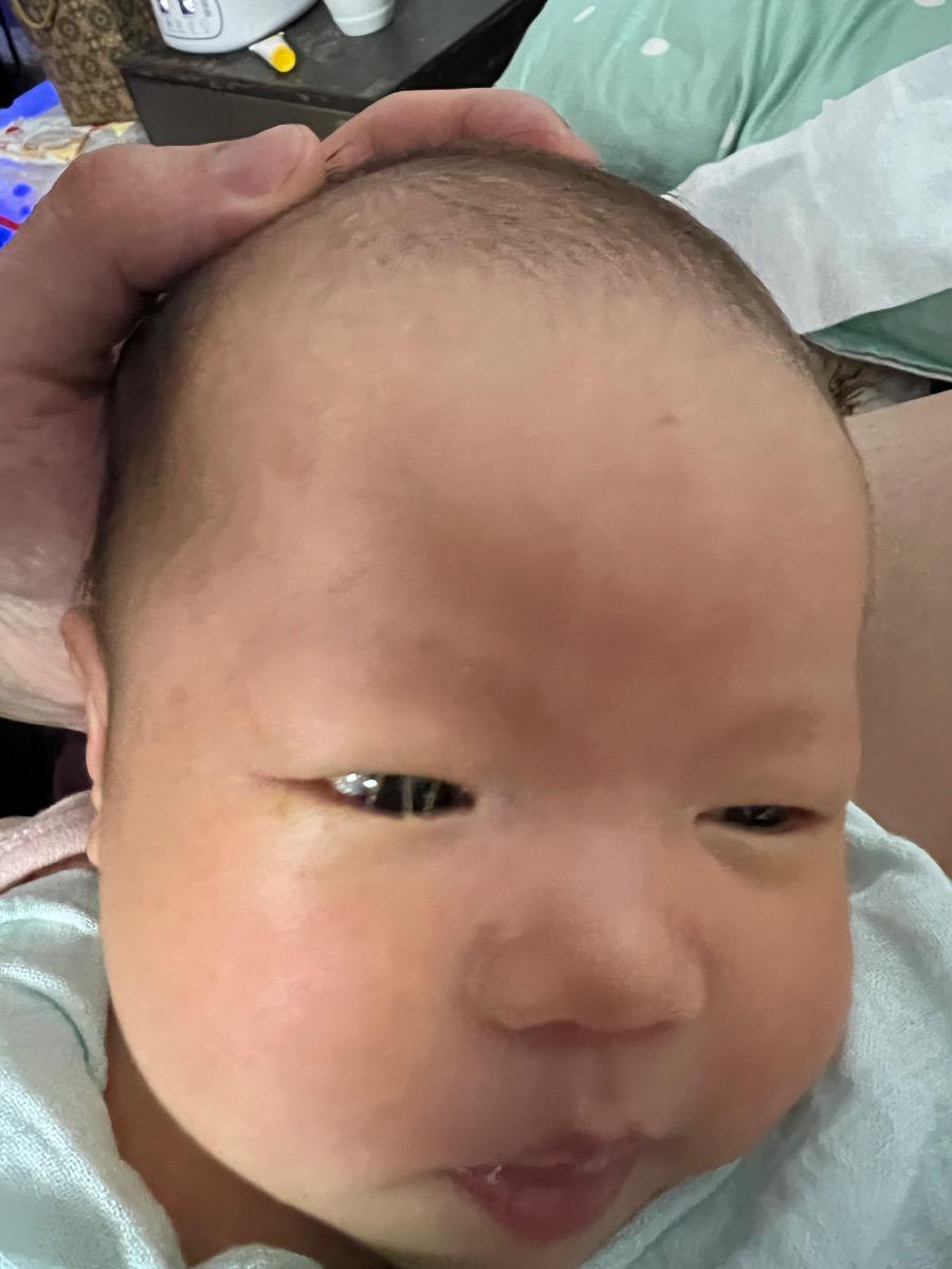 Như hình ảnh m gửi nha bạn. Bạn xem giúp mình với, và thường do bị gi mà cháu bị thế này để m tránh. Đang lo là tay bé ngoắc vào mắt khi bé 28 ngày tuổi hay bị ợ trớ đầy hơi bạn ạ. Cảm ơn.