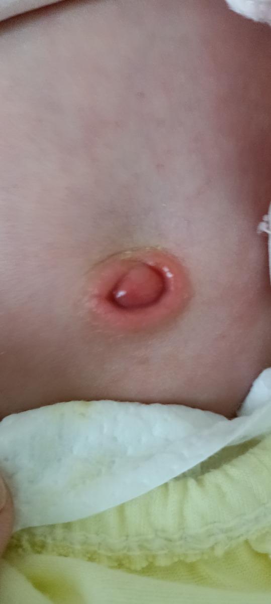 Bé nhà em sinh được 1 tháng nhưng rốn vãn chưa khô