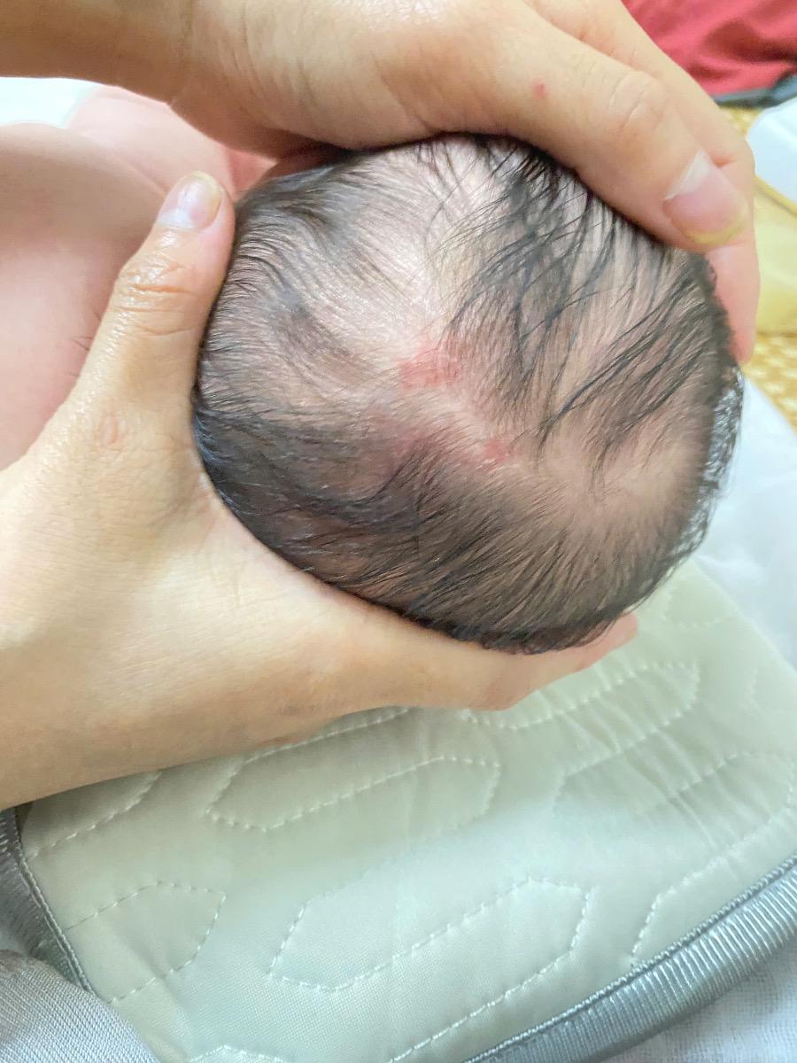 Con em bị mảng đảo trên đầu nhìn như viêm da, 3 hôm rùi chưa đỡ. Em cần xử lý như thế nào?