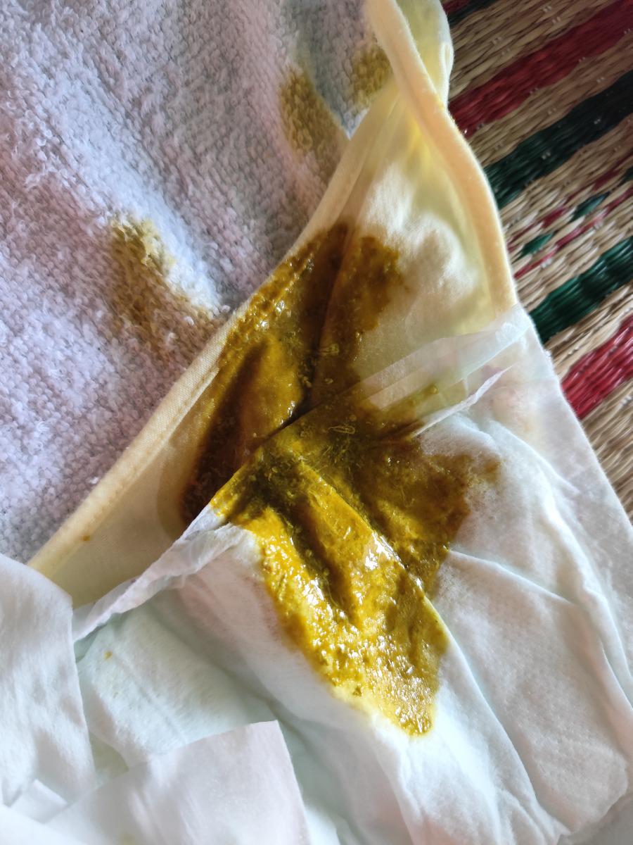 Chào anh/chị. Cháu nhà em 3 hôm nay đi phân hơi nhầy, có khi đi hơi lỏng. Em có mang phân lên bác sỹ tư,nhờ tư vấn. Bác bảo bé bị dư đường, dừng 2 ngày sữa mẹ, dùng sữa Nan. Em có nên theo hay là phải mang phân bé đến bệnh viện để xét nghiệm. Em sợ cháu bị bất dung nạp đường. Bé vẫn chơi,bú, ngủ ngoan ạ
Ngoài ra, chế độ ăn của em gần đây em có ăn sữa chua TH true milk k đường, việc ăn sữa chua có ảnh hưởng gid đến phân em bé k ạ. 
 Mong đk tư vấn.
Em cảm ơn