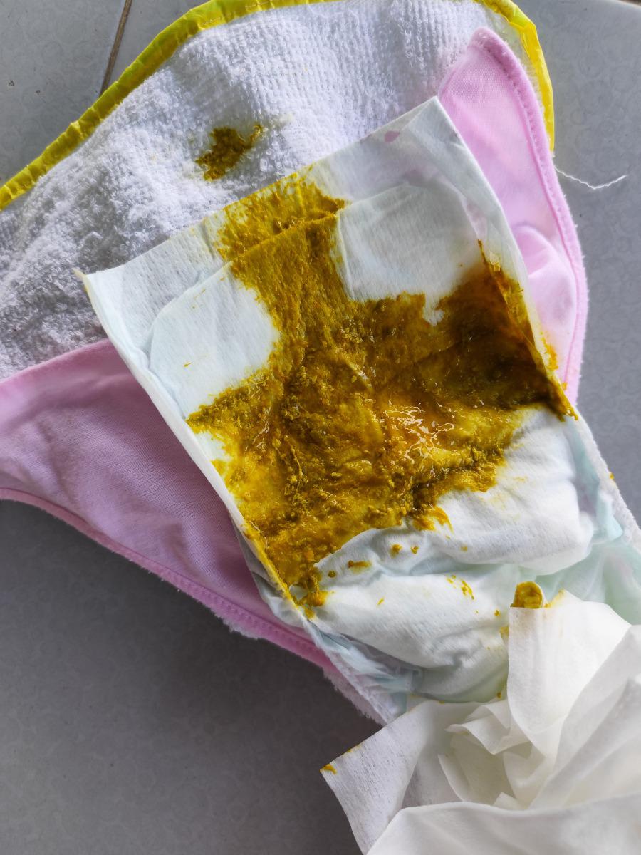 Chào anh/chị. Cháu nhà em 3 hôm nay đi phân hơi nhầy, có khi đi hơi lỏng. Em có mang phân lên bác sỹ tư,nhờ tư vấn. Bác bảo bé bị dư đường, dừng 2 ngày sữa mẹ, dùng sữa Nan. Em có nên theo hay là phải mang phân bé đến bệnh viện để xét nghiệm. Em sợ cháu bị bất dung nạp đường. Bé vẫn chơi,bú, ngủ ngoan ạ
Ngoài ra, chế độ ăn của em gần đây em có ăn sữa chua TH true milk k đường, việc ăn sữa chua có ảnh hưởng gid đến phân em bé k ạ. 
 Mong đk tư vấn.
Em cảm ơn