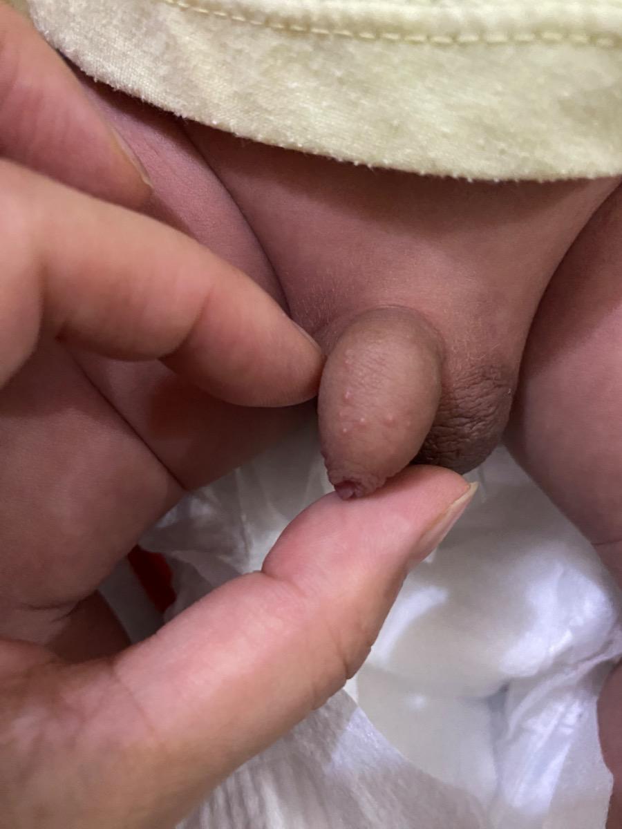 Xin chào,
Bé nhà mình 29 ngày, hôm nay phát hiện chim mọc một số nốt nhỏ. 
Nhờ bạn xem giúp có phải bất thường không?
Hiện người bé các chỗ khác ko có nốt gì khác. 
Bé ăn ngủ bình thường, chỉ là giấc ngày mấy hôm nay ngủ không sâu