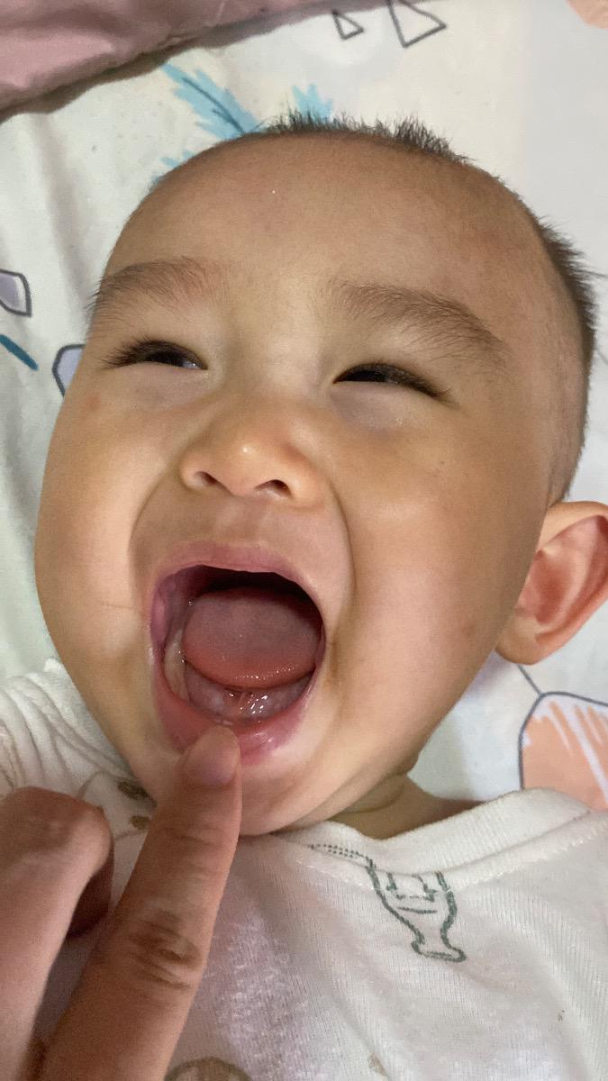 Có phải bé bị dính thắng lưỡi và phanh môi trên không ạ