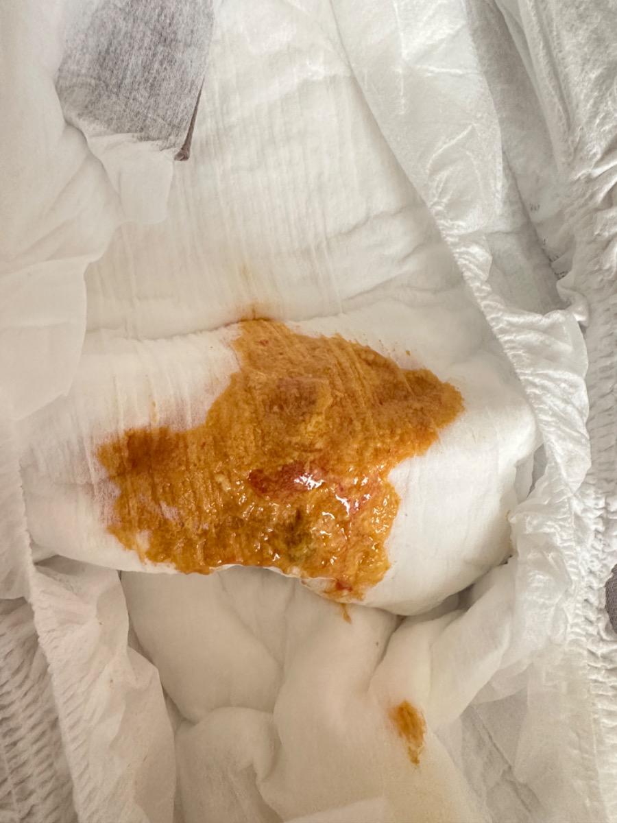 Bé 3m8d đi phân hơi lỏng có lợn cợn máu là dấu hiệu j.
Mấy hôm nay mẹ ăn sầu riêng có phải dẫn đến lý do sữa nóng nên trẻ đi phân có máu?