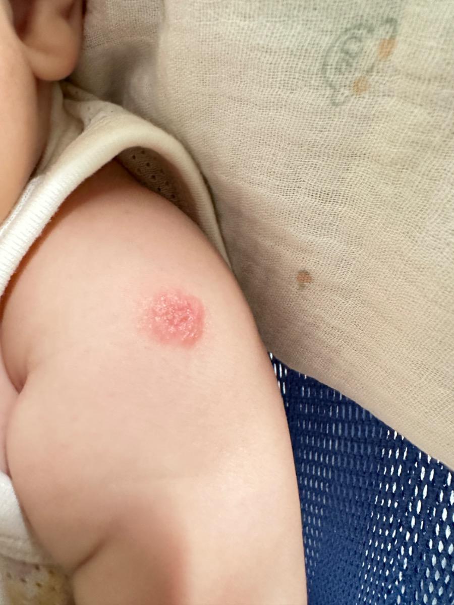 Bé 3m10d đến nay vết tiêm ngừa lao vẫn đỏ, thỉnh thoảng nhìn vết nhỏ, thỉnh thoảng to to như vậy thì có bình thường ko ạ. Vết này đường kính tầm 1cm.