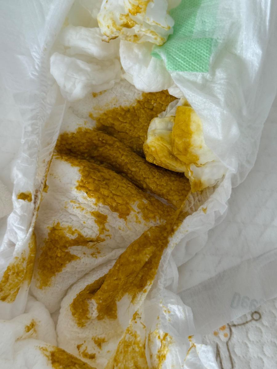 Em bé nhà mình 4m5d. Từ khi tiêm 6in1 và phế cầu lúc 4 tháng, bé thay đổi vấn đề đi tiêu.
Trước đó từ khi giãn ruột đến  4 tháng bé chỉ đi trung bình 2-3 ngày 1 lần. Nhưng lúc tiêm 4M về thì trung bình bé xì xoẹt 3-4 lần/ngày, cứ lúc nào cho bú (bé bú bình sữa mẹ/sct) thì bé lại đi tiêu. Phân có mùi hôi (như trước đây bình thường vẫn có), thấy k bị loãng nước. Như vậy có bình thường không và lúc nào nên cho bé đi khám vì sợ tiêu chảy ạ? Bé vẫn ăn ngủ chơi bình thường.
Em gửi màu phân của bé.

Em cám ơn ạ.