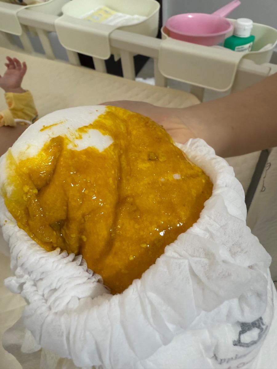 Em bé nhà mình 4m5d. Từ khi tiêm 6in1 và phế cầu lúc 4 tháng, bé thay đổi vấn đề đi tiêu.
Trước đó từ khi giãn ruột đến  4 tháng bé chỉ đi trung bình 2-3 ngày 1 lần. Nhưng lúc tiêm 4M về thì trung bình bé xì xoẹt 3-4 lần/ngày, cứ lúc nào cho bú (bé bú bình sữa mẹ/sct) thì bé lại đi tiêu. Phân có mùi hôi (như trước đây bình thường vẫn có), thấy k bị loãng nước. Như vậy có bình thường không và lúc nào nên cho bé đi khám vì sợ tiêu chảy ạ? Bé vẫn ăn ngủ chơi bình thường.
Em gửi màu phân của bé.

Em cám ơn ạ.