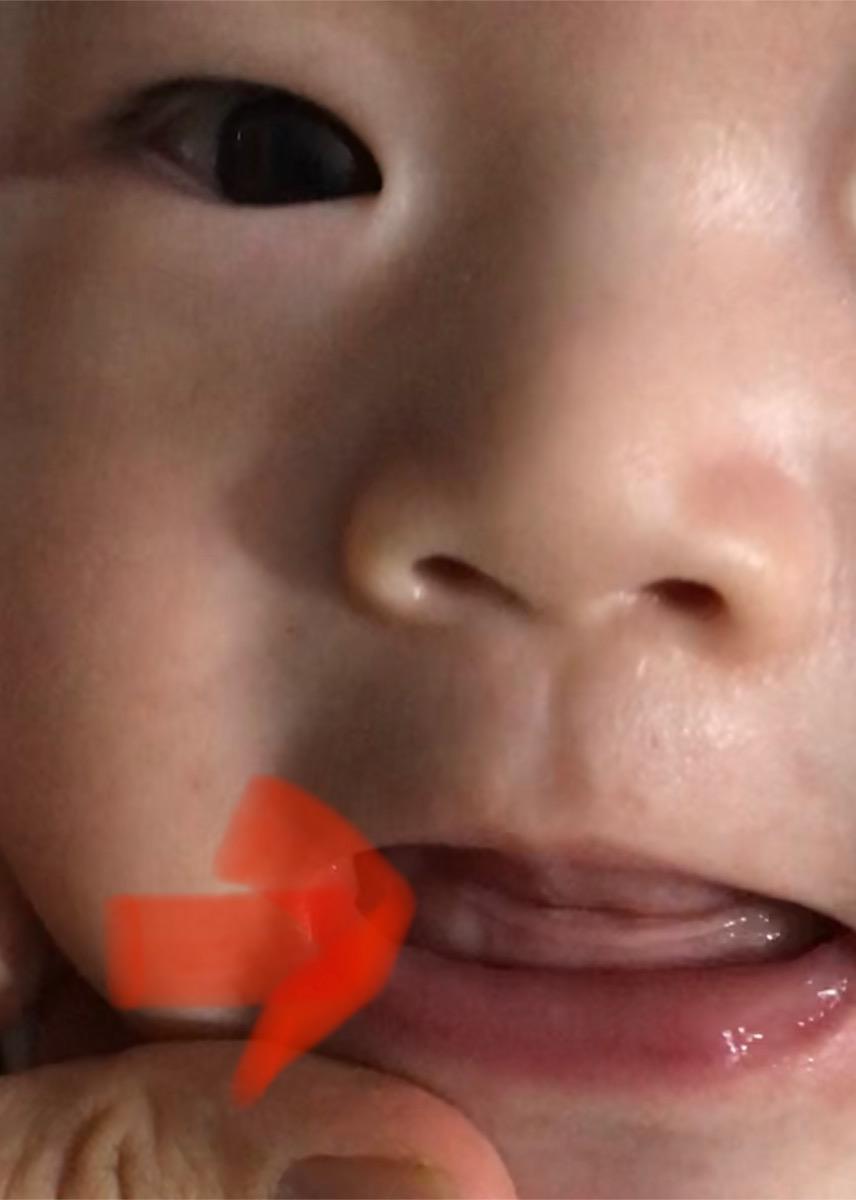 Bé mình Hnay thấy có chỗ xưng chỗ nướu (như hình) ko bik là nanh sữa hay bị xưng viêm, trc đó ko thấy. 
Ad xme giúp mình ?
Và bé mình hay mút tay, có cách nào hạn chế đc ko ?