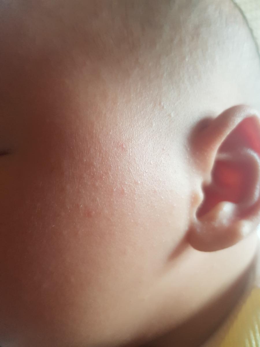 Bé nhà em 2 tháng dạo này nổi nhiều nốt nhỏ quanh 2 bên má, mắt, cổ, da đầu, gáy. Đó là nốt rôm sảy phải không hay là nốt gì? Cách chữa trị như thế nào?