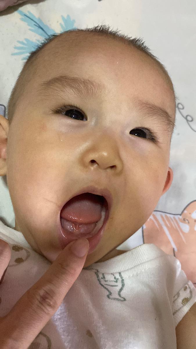 Có phải bé bị dính thắng lưỡi và phanh môi trên không ạ