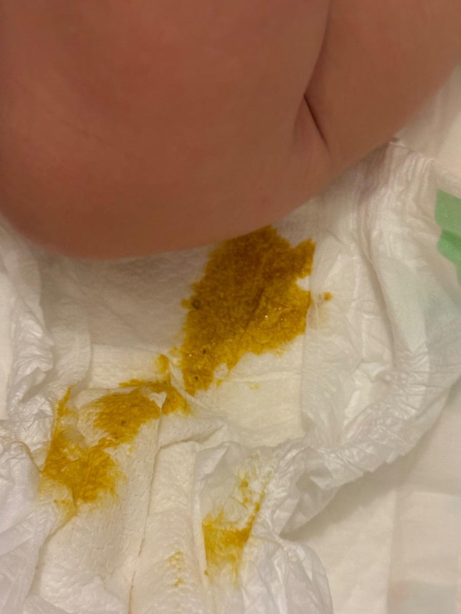 Em bé nhà mình 4m5d. Từ khi tiêm 6in1 và phế cầu lúc 4 tháng, bé thay đổi vấn đề đi tiêu.
Trước đó từ khi giãn ruột đến  4 tháng bé chỉ đi trung bình 2-3 ngày 1 lần. Nhưng lúc tiêm 4M về thì trung bình bé xì xoẹt 3-4 lần/ngày, cứ lúc nào cho bú (bé bú bình sữa mẹ/sct) thì bé lại đi tiêu. Phân có mùi hôi (như trước đây bình thường vẫn có), thấy k bị loãng nước. Như vậy có bình thường không và lúc nào nên cho bé đi khám vì sợ tiêu chảy ạ? Bé vẫn ăn ngủ chơi bình thường.
Em gửi màu phân của bé.

Em cám ơn ạ.