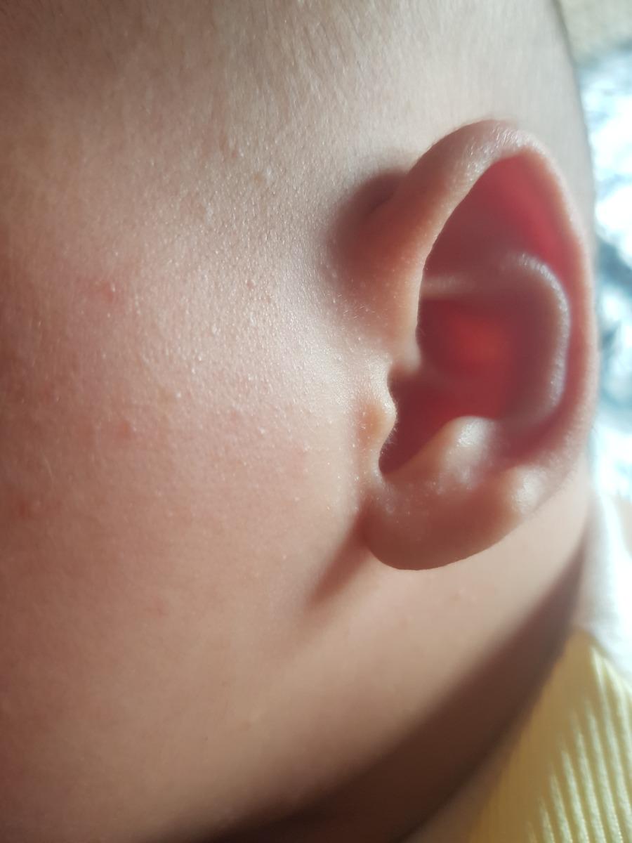 Bé nhà em 2 tháng dạo này nổi nhiều nốt nhỏ quanh 2 bên má, mắt, cổ, da đầu, gáy. Đó là nốt rôm sảy phải không hay là nốt gì? Cách chữa trị như thế nào?