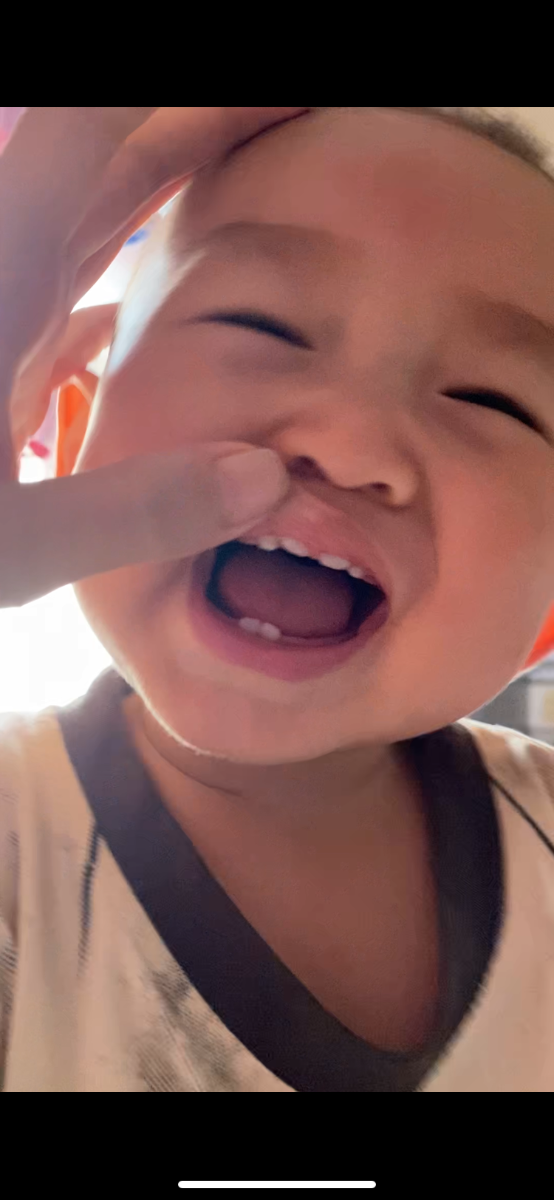 Có phải bé bị dính thắng lưỡi và phanh môi trên không ạ