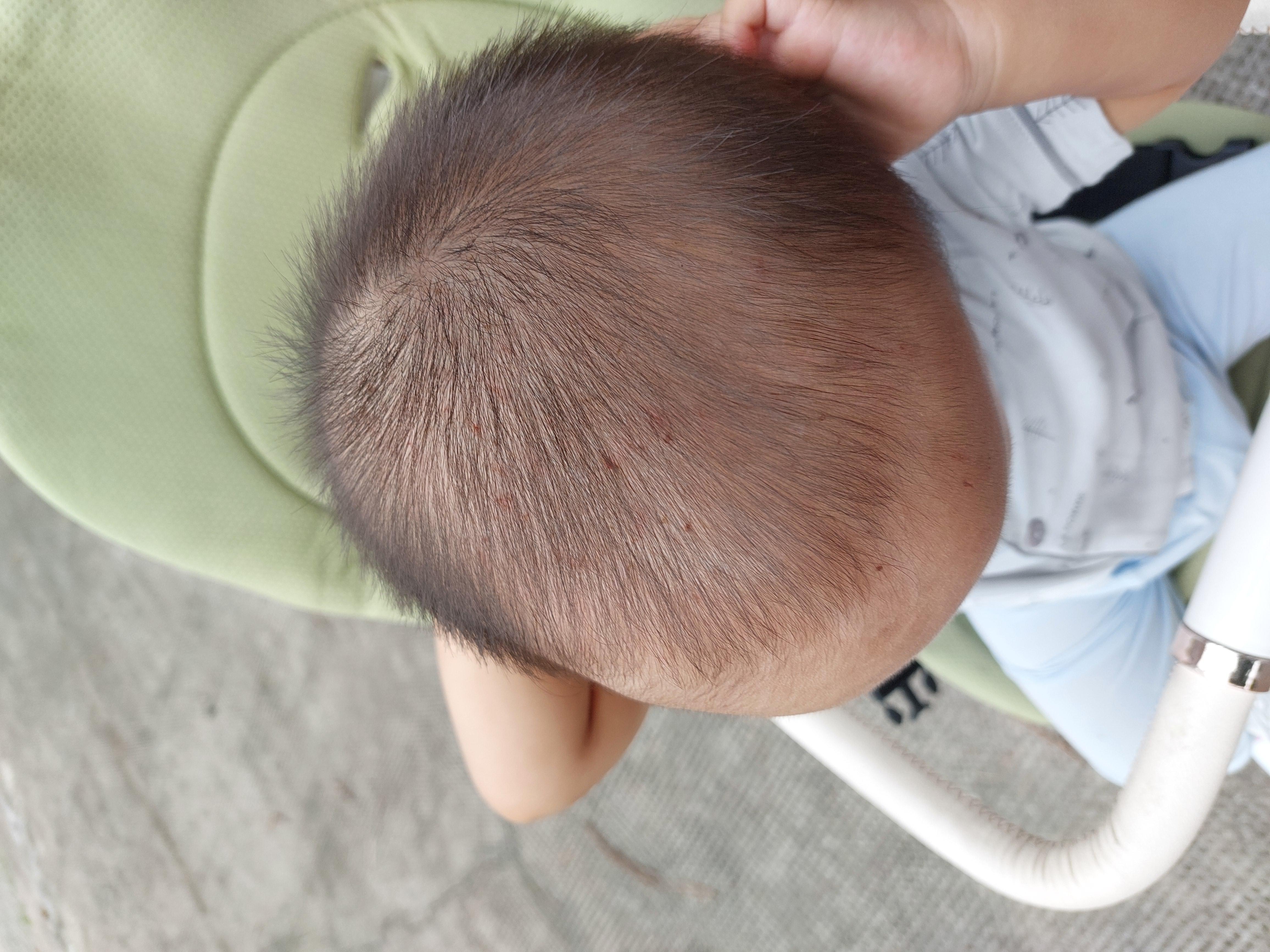 Bé mình hơn 13 tháng, có 8 răng, bé 10kg .dạo gần đây bé hay ngứa đầu như hình. Và có nốt côn trùng cắn đỏ rồi ngứa, bé hay gãi nên nặng hơn
Anh chị cho e hỏi là có thuốc bôi gì đỡ ngứa cho bé ko và có nên đi khám ko ( vì bé rất sợ bác sỹ)