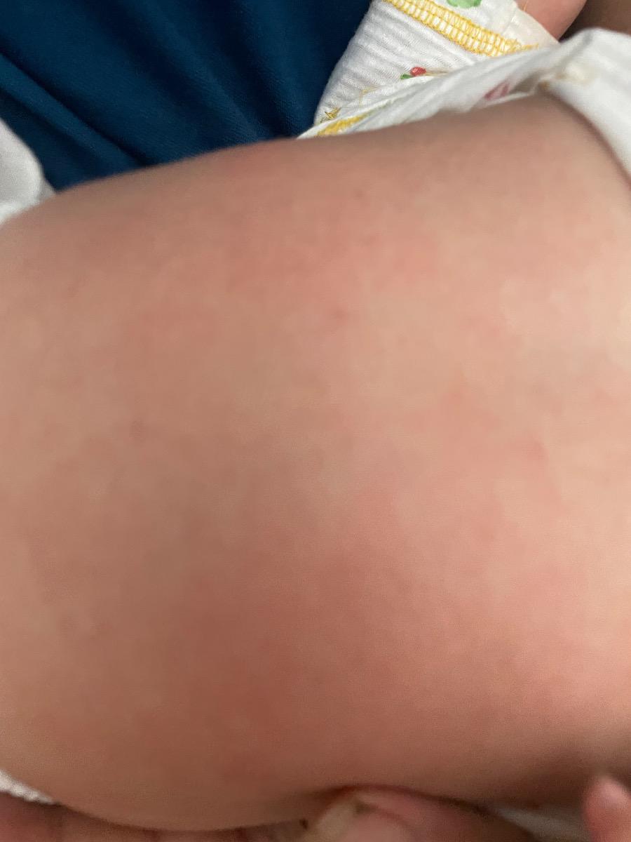 Bé bị nổi mận đỏ li ti khắp người, vùng cổ và bẹn bị đỏ, chảy nước thì có phải viêm da cơ địa ko và sử dụng kem bôi gì hiệu quả ạ