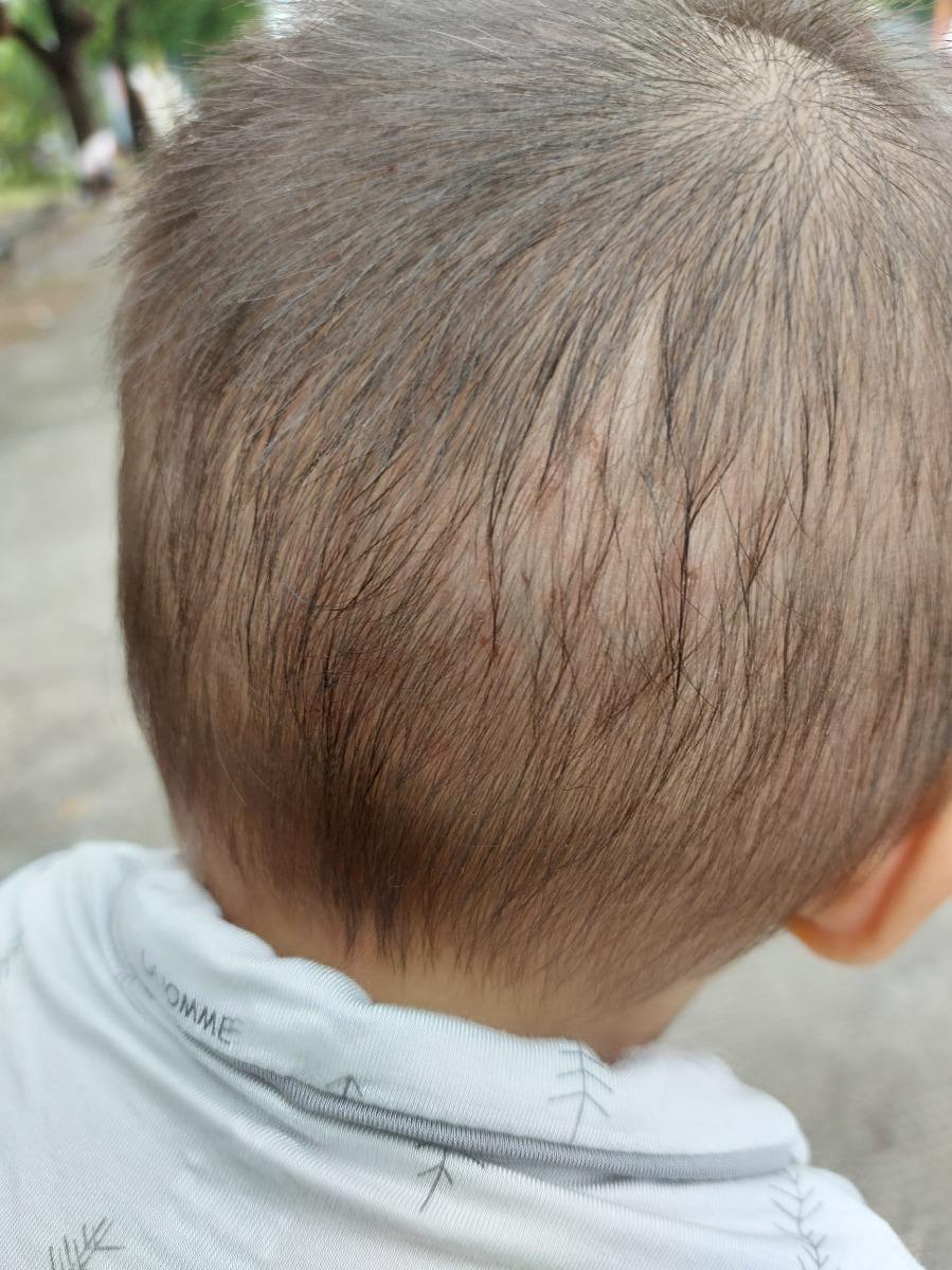 Bé mình hơn 13 tháng, có 8 răng, bé 10kg .dạo gần đây bé hay ngứa đầu như hình. Và có nốt côn trùng cắn đỏ rồi ngứa, bé hay gãi nên nặng hơn
Anh chị cho e hỏi là có thuốc bôi gì đỡ ngứa cho bé ko và có nên đi khám ko ( vì bé rất sợ bác sỹ)