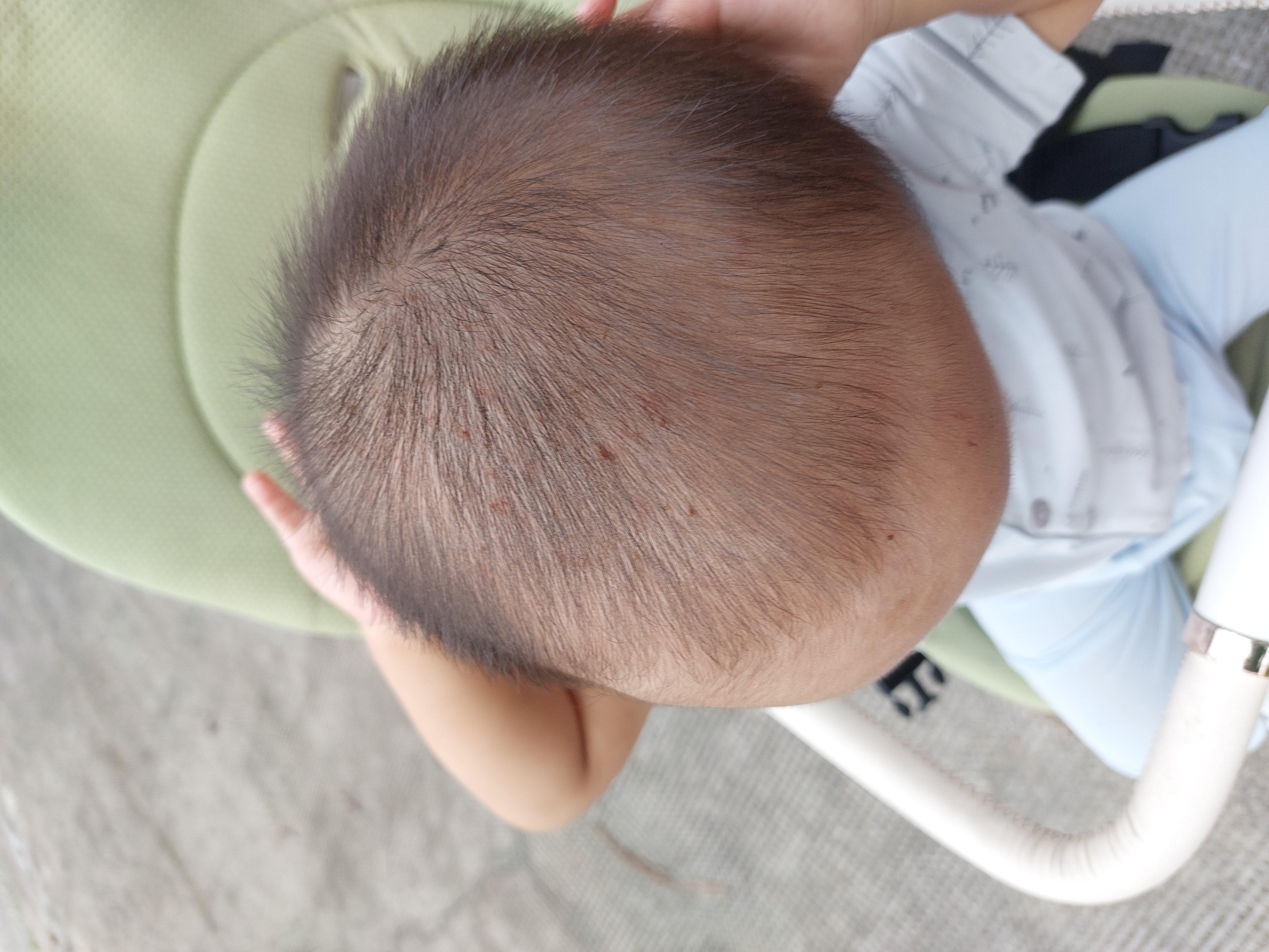 Bé mình hơn 13 tháng, có 8 răng, bé 10kg .dạo gần đây bé hay ngứa đầu như hình. Và có nốt côn trùng cắn đỏ rồi ngứa, bé hay gãi nên nặng hơn
Anh chị cho e hỏi là có thuốc bôi gì đỡ ngứa cho bé ko và có nên đi khám ko ( vì bé rất sợ bác sỹ)