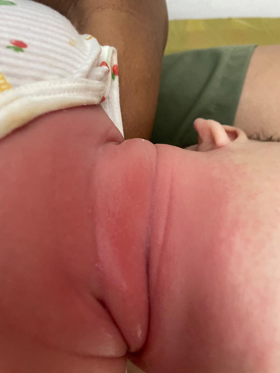 Bé bị nổi mận đỏ li ti khắp người, vùng cổ và bẹn bị đỏ, chảy nước thì có phải viêm da cơ địa ko và sử dụng kem bôi gì hiệu quả ạ