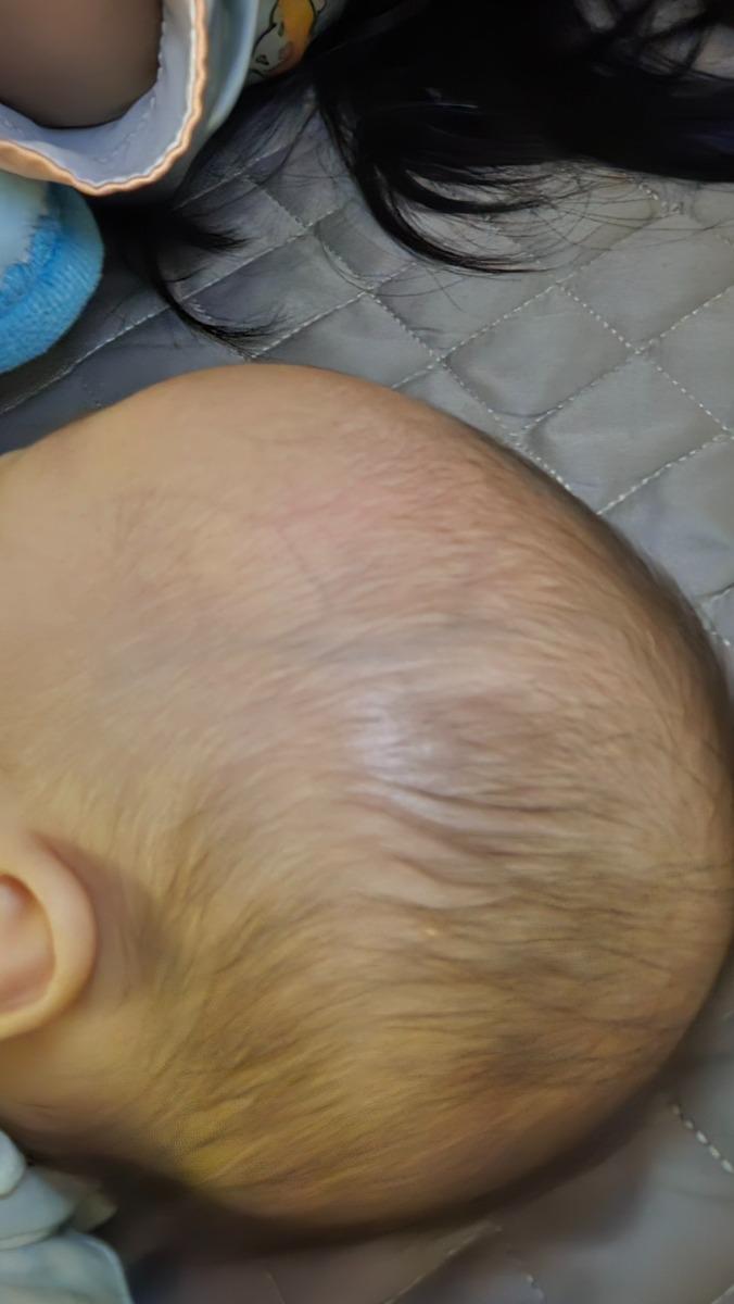 Bé nhà nk 2M20D có dấu hiệu rụng tóc vành khăn và ra mồ hôi khi bú/bế khoảng 1 tuần gần đây. Mình đang bổ sung sáng D3K của special kid (10mcg d3 và 15mcg k2). 
Mình định bổ sung thêm dha nordic naturals thêm đc ko? Cả 2 đều khuyến nggij uống buổi sáng, vậy mk nên cho bé uống ntn ạ (cách nhau bn phút? Trc mấy h?...) 
Cảm ơn chuyên gia